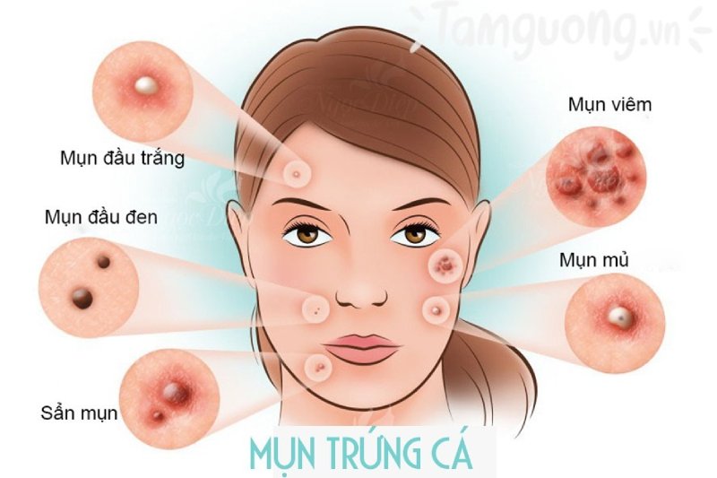 cách điều trị mụn trứng cá hiệu quả nhất