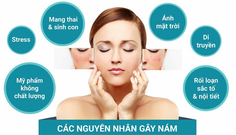 cách điều trị nám da mặt lâu năm