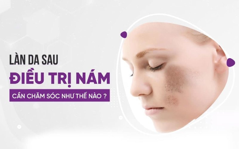 chăm sóc sau điều trị nám