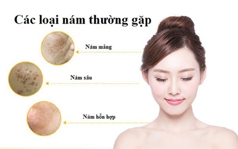 công nghệ điều trị nám mới nhất