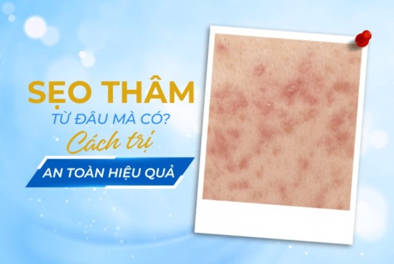 điều trị thâm sẹo lâu năm